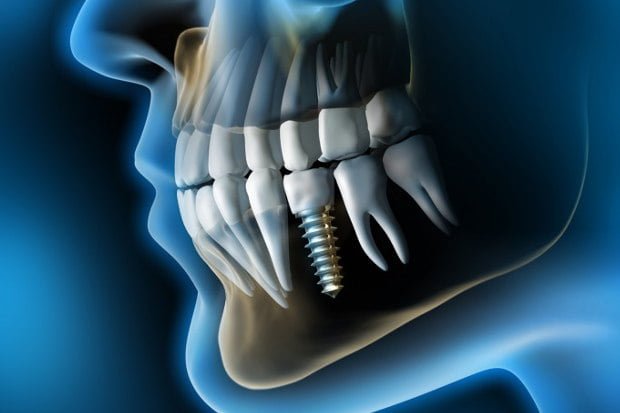 This allows the creation of an accurate surgical template to place the implants as well as for greater security.