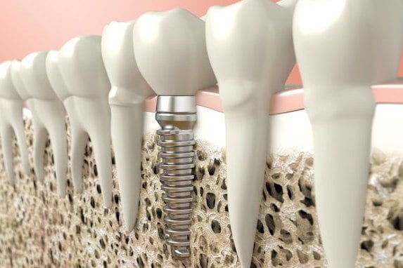 beneficios de los Implantes dentales